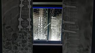 Spine fracture fracture spine operationpolo [upl. by Ogdon865]