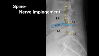 Spine Nerve Impingement [upl. by Sophey]