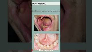 salivary glands sialolithiasis [upl. by Alleinnad]