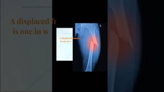 Bone fracture orthopedics bones [upl. by Ladd]