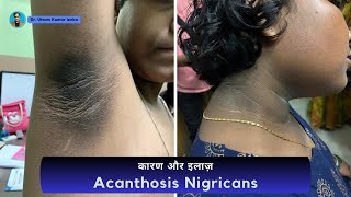 Acanthosis nigricans Treatment  dark neck treatment  काले गर्दन का इलाज  Dr Uttam Kumar Lenka [upl. by Ludwigg]