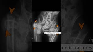 Bilateral subtrochanteric femoral fractures xray [upl. by Brothers637]