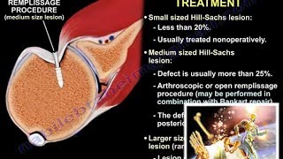 Lesions Of The Shoulder  HillSachs Lesion  Everything You Need To Know  Dr Nabil Ebraheim [upl. by Giuditta]