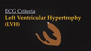 ECG Criteria for Left Ventricular Hypertrophy LVH [upl. by Naillig]