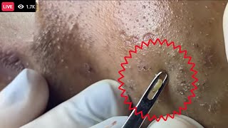 Cystic Acne pimples amp Blackheads Extraction On face Acne Treatment part  Most satisfying face HD [upl. by Aiva393]