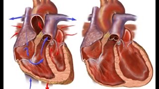 Congestive Heart Failure [upl. by Ahsenyl366]