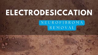 NF Surgeon Explains Electrodesiccation for NF1 Tumors [upl. by Noivad]