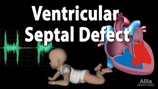 Ventricular Septal Defect Animation [upl. by Ebby]