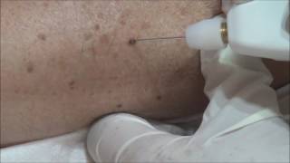 Angioma Removal with Plexr [upl. by Eittik]