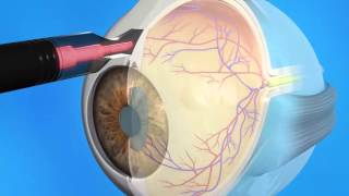 Glaucoma Cyclophotocoagulation CPC [upl. by Nycila]