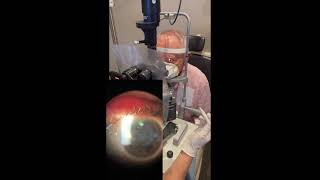 Durysta Implantation at the Slit Lamp [upl. by Dame]