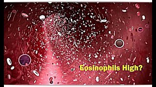 Eosinophils High Low – Causes [upl. by Fifi273]