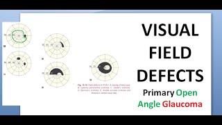 Ophthalmology 236 c Visual Field Defects POAG Primary Open Angle Glaucoma Treatment Laser Surgery [upl. by Dex]