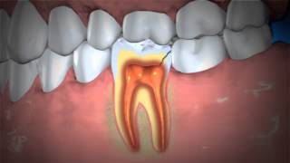 Treatment of Abscessed Teeth [upl. by Rahcir]