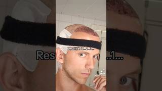 New hairline after hair transplant [upl. by Arleyne]