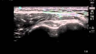 How To Biceps Tendon Ultrasound Exam Scanning Technique [upl. by Volnak900]