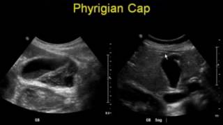 Errors in Gallbladder Ultrasound [upl. by Ahsitra824]