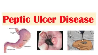 Peptic Ulcer Disease Gastric vs Duodenal Ulcers  Causes Symptoms Diagnosis Treatment [upl. by Florentia815]