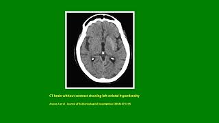 Neurology Quiz 84 Diabetic Striatopathy [upl. by Ahab]