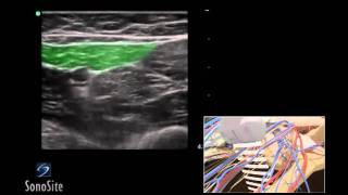 How To Ultrasound Guided Saphenous Nerve Block 3D Video [upl. by Sine]