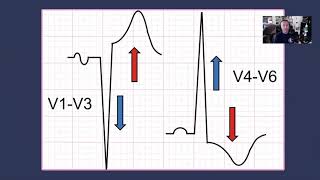 Left Ventricular Hypertrophy [upl. by Makell]