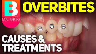 Deep Overbite Bite amp Braces Causes and Correction  Orthodontic Treatments [upl. by Poliard94]