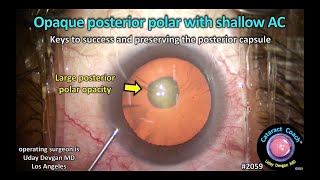 CataractCoach™ 2059 opaque post polar cataract with a shallow AC [upl. by Alleul]