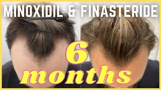 Minoxidil amp Finasteride  6 Month Update  Christopher Painter [upl. by Narmak262]