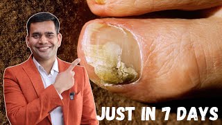 Just in 7 Days Cure Toenail Fungus At Home  Best Remedy For Toenail Fungus  Dr Vivek Joshi [upl. by Drawyeh753]