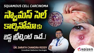 BEST treatment for squamous cell carcinoma  DrSarath Chandra Reddy  Kaizen Hematology Network [upl. by Sumaes]