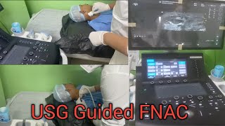 FNAC  Fine Niddle Aspiration Cytology  USG Guided FNAC  Procedure [upl. by Auqinu517]