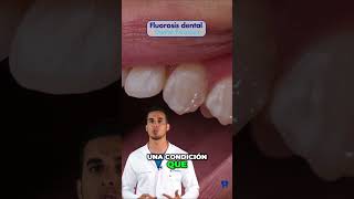 ¿Tienes MANCHAS en los dientes Podría ser FLUOROSIS dental [upl. by Erickson835]