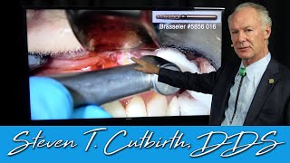 Endodontics amp Apicoectomy on a Lateral Incisor  Dental Minute with Steven T Cutbirth DDS [upl. by Yelhs]