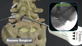 Sciatica Surgery Dr John Small  Florida Orthopaedic Institute [upl. by Vitus]