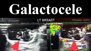 Galactocele  Lactocele  Benign Breast Lesion [upl. by Netram]