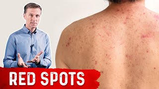 Why Red Spots on My Skin – DrBerg on Skin Red Spots Causes amp Remedies [upl. by Ardnuasac]