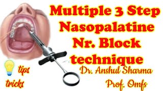 NASOPALATINE NERVE BLOCKLANDMARKSTECHNIQUECOMPLICATIONMALAMEDMULTIPLE PENETRATION TECHNIQUETIP [upl. by Curran]