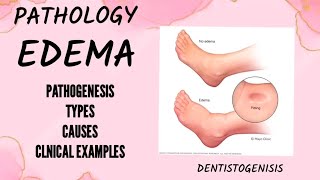 edema  oedema  pathology bds2ndyear bds pathology [upl. by Aimil968]