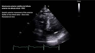 MIOCARDIOPATIA HIPERTROFICA OBSTRUTIVA  OBSTRUCTIVE HYPERTROPHIC MYOCARDIOPATHY [upl. by Hardman711]