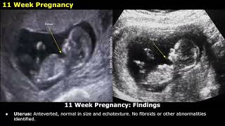 Obstetric Ultrasound Reporting  How To Write USG Reports  Pregnancy Sonography  TIFFA Scan [upl. by Oralie998]