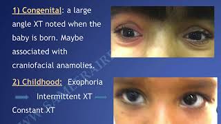 A one hour lecture of Exotropia By Dr Sameera [upl. by Irbua]