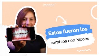 Opiniones Moons  Daniela comparte cómo vio los cambios en sus dientes usando Moons [upl. by Rehsu]