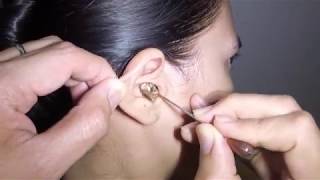 Womans Earwax Finally Removed after 25 Years [upl. by Terrab]