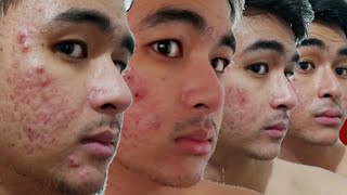 100 DAYS OF ISOTRETINOIN TIMELAPSE  Accutane Acnetrex Progress Video  KevInSeries [upl. by Eanore540]