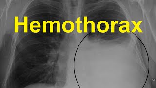 Hemothorax Symptoms Causes and Treatment [upl. by Auqeenahs]