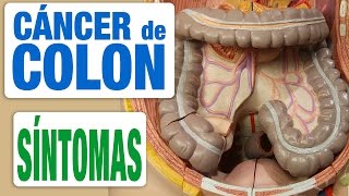 Cáncer de Colon  Síntomas [upl. by Mcgregor]