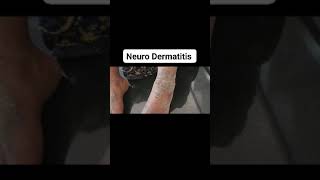 Lichen Simplex ChronicusNeuro Dermatitis dermatologist dr Bhutada Skin India [upl. by Willner]