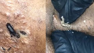 Severe Blackhead Removal  Cystic Elderly Acne Treatment  Whitehead Hidden Acne Spa Relaxing  142 [upl. by Aillicec]