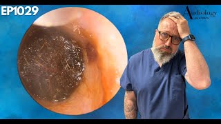 INSANE DEEP EAR WAX PLUG REMOVAL  EP1029 [upl. by Htenywg]