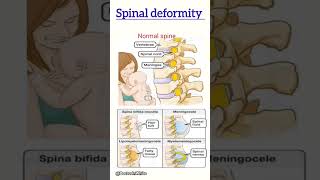 Spinal deformity  viralvideos spinaldecompression deformity [upl. by Aneela225]